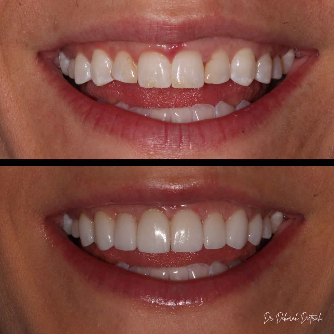 before and after Veneers plaza dental (4)