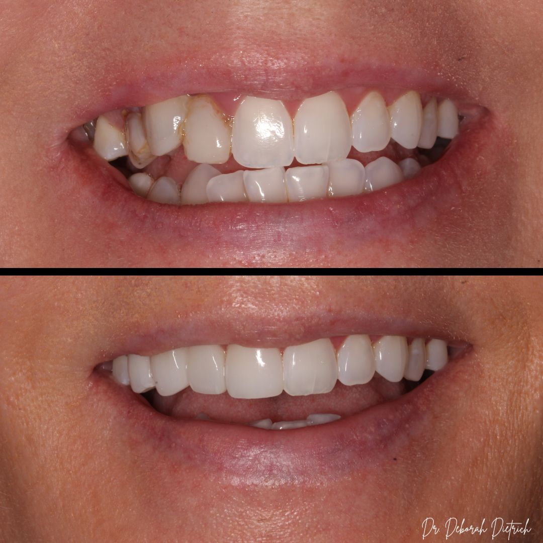 before and after Veneers plaza dental (4)