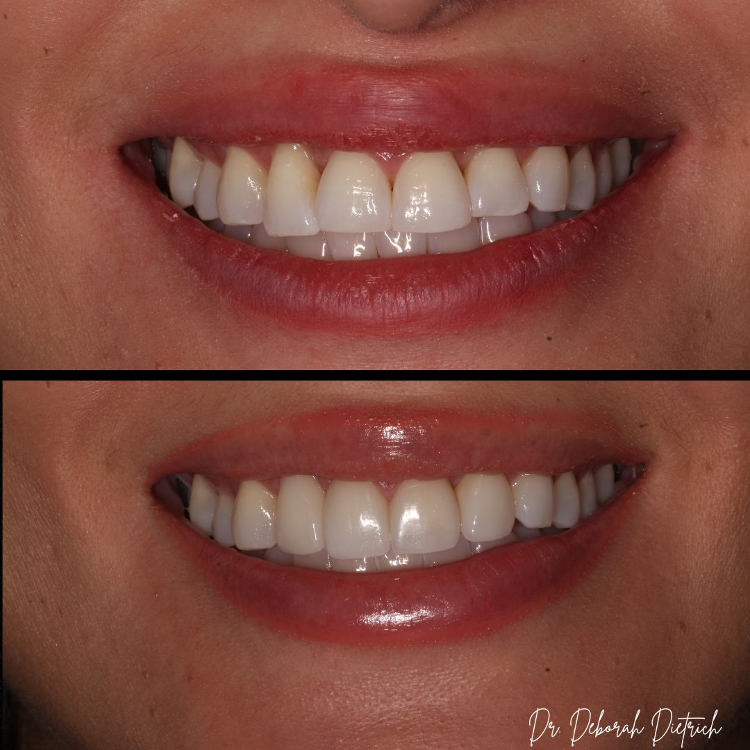 before and after Veneers plaza dental (4)