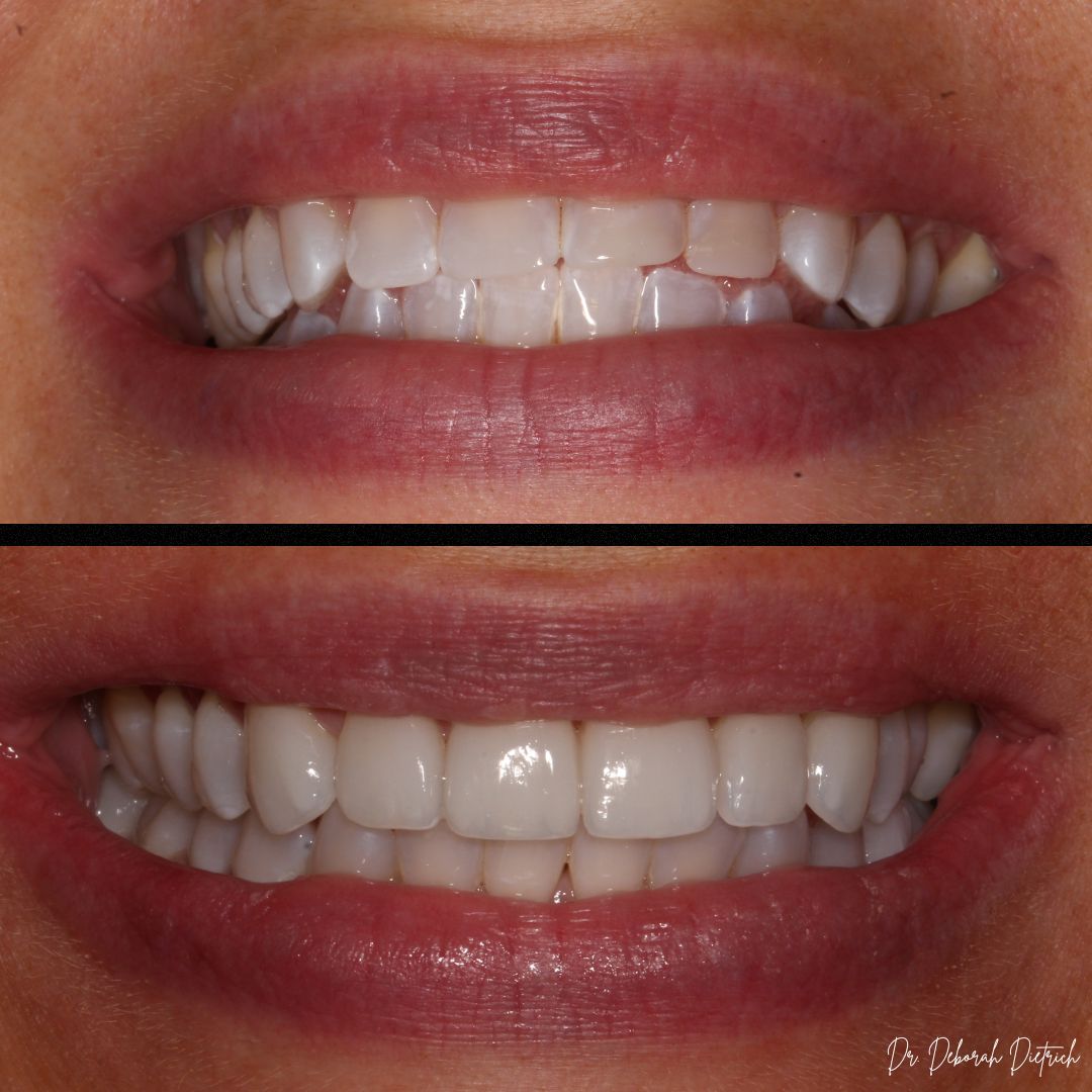 Plaza Dental Group Urbandale - Porcelain Veneers