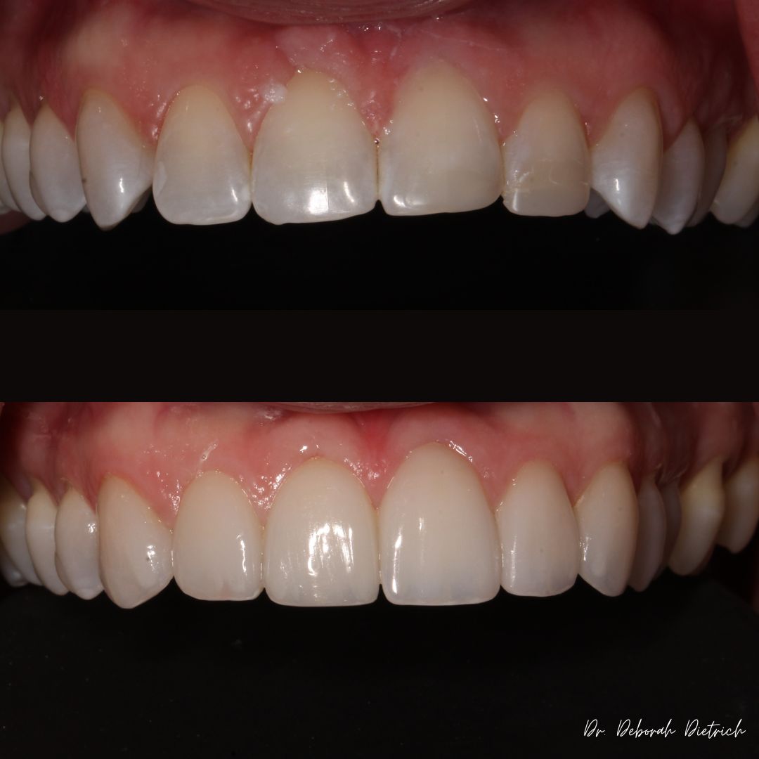 before and after Veneers plaza dental (4)