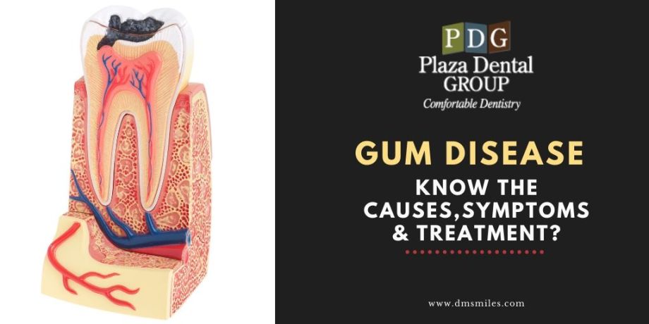 gum-disease-typessymptoms-treatment-1