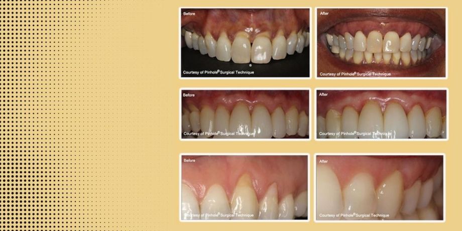 Chao Pinhole Surgical Technique in Urbandale