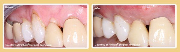 Before and After PST