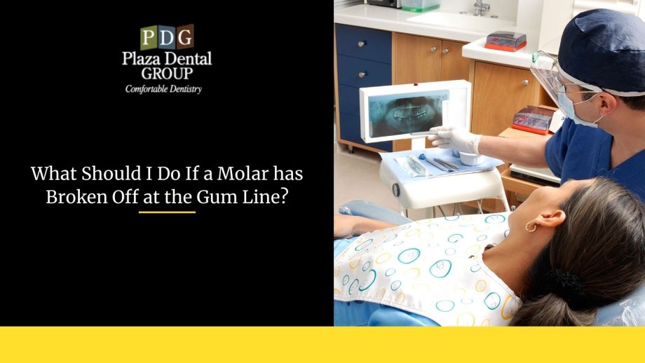 what-should-i-do-if-a-molar-has-broken-off-at-the-gum-line
