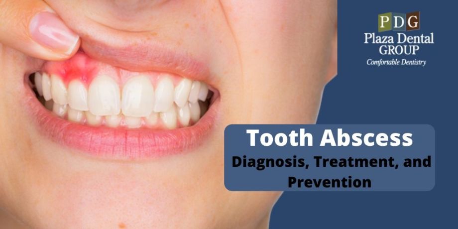 tooth-abscess-diagnosis-treatment-and-prevention-1