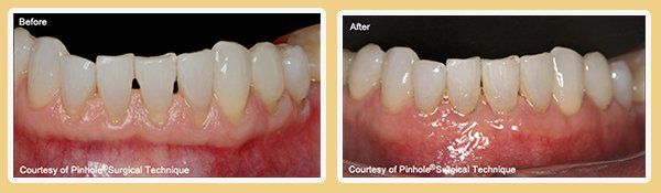 Before and After PST