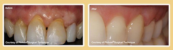 Before and After PST